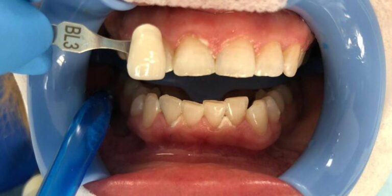 Metamorfoza – wybielanie 10 - po