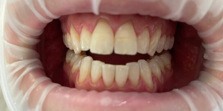 Metamorfoza – wybielanie 11 - przed