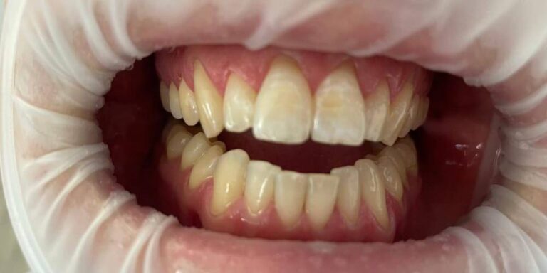 Metamorfoza – wybielanie 11 - po