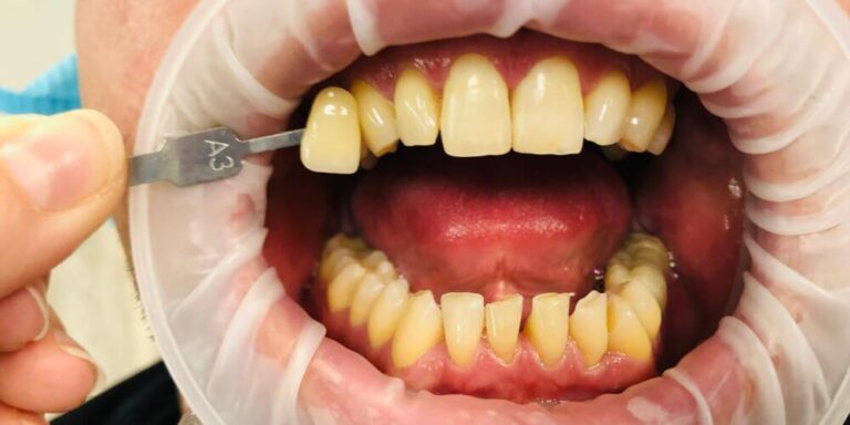 Metamorfoza – wybielanie - przed