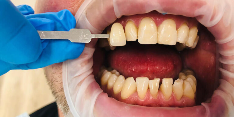 Metamorfoza – wybielanie - po