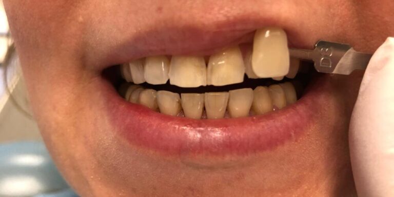 Metamorfoza – wybielanie 2 - przed