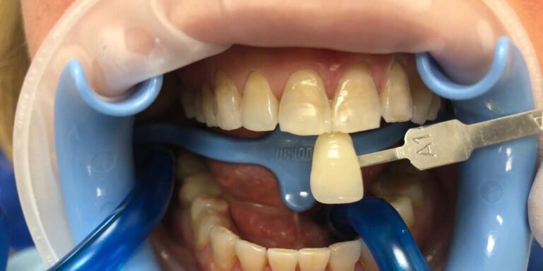 Metamorfoza – wybielanie 2 - po