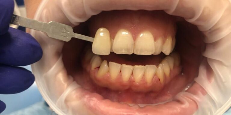 Metamorfoza – wybielanie 3 - przed