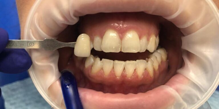 Metamorfoza – wybielanie 3 - po