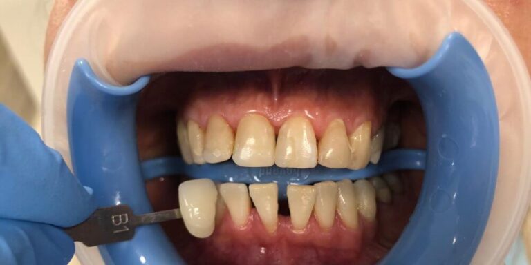 Metamorfoza – wybielanie 4 - po