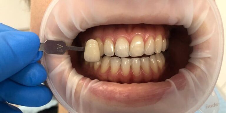 Metamorfoza – wybielanie 6 - przed