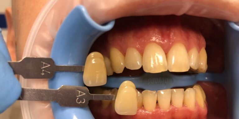 Metamorfoza – wybielanie 9 - przed